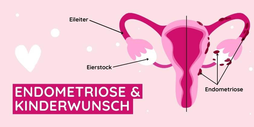 Grafische Darstellung einer Endometriose