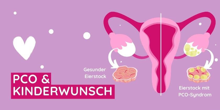 Die Gebärmutter mit PCO bei Kinderwunsch